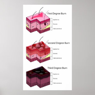 Skin Brennen Erste und Dritte Stufe Diagramm Poster