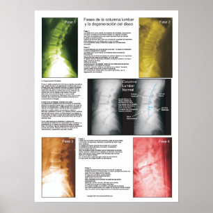 Spanisches Phases Lumbar Spinal Degenerations Post Poster
