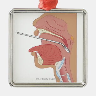 SpiegelLaryngoscopy Silbernes Ornament