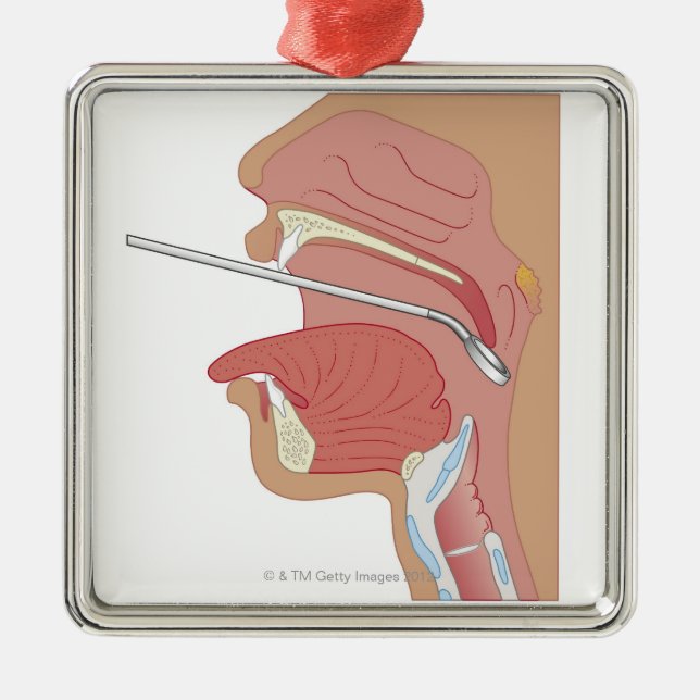 SpiegelLaryngoscopy Silbernes Ornament (Vorne)
