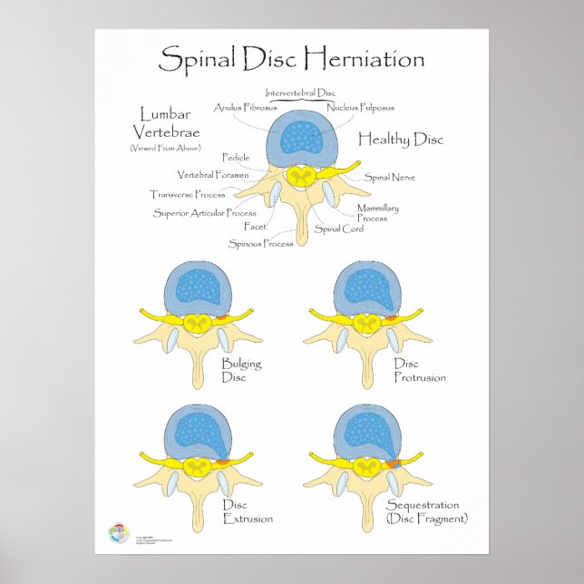 Spinal Disc Herniveau Poster Medical Poster (Vorne)