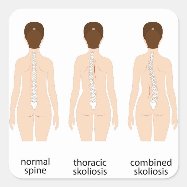 Spinalfehler Quadratischer Aufkleber (Vorderseite)