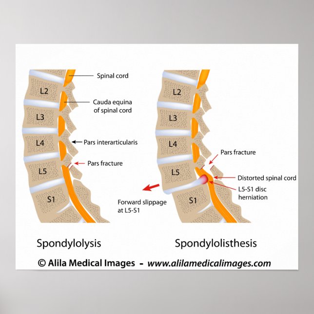 Spondylolyse und Spondylolisthese, gekennzeichnet Poster (Vorne)