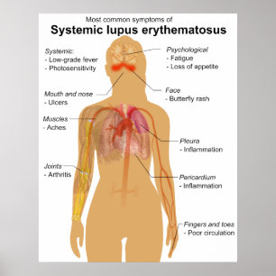 Symptomdiagramm des systemischen Lupus Erythematod Poster