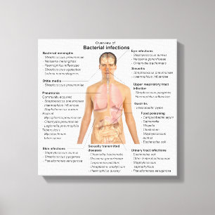 Tabelle der bakteriellen Infektionen beim Menschen Leinwanddruck