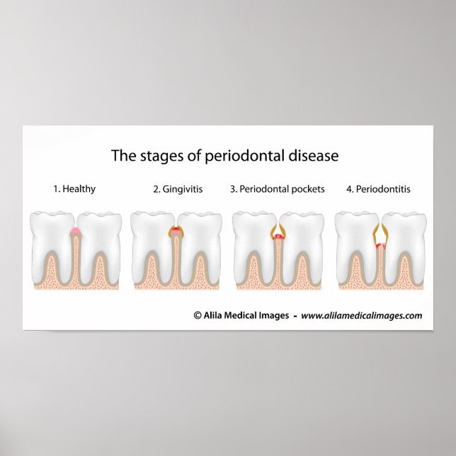 Tooth Periodontal Disease Poster (Vorne)
