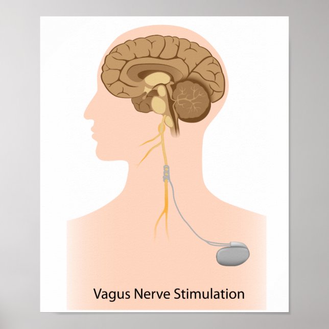 Vagus Nervenstimulation Poster (Vorne)