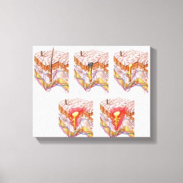 Verschiedene Arten von Akne Leinwanddruck (Vorderseite)