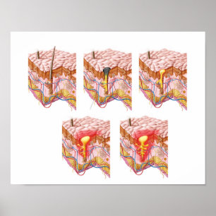 Verschiedene Arten von Akne Poster