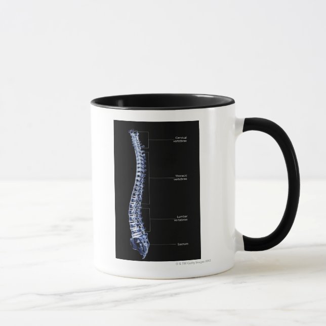 Vertebrale Spalte 4 Tasse (Rechts)