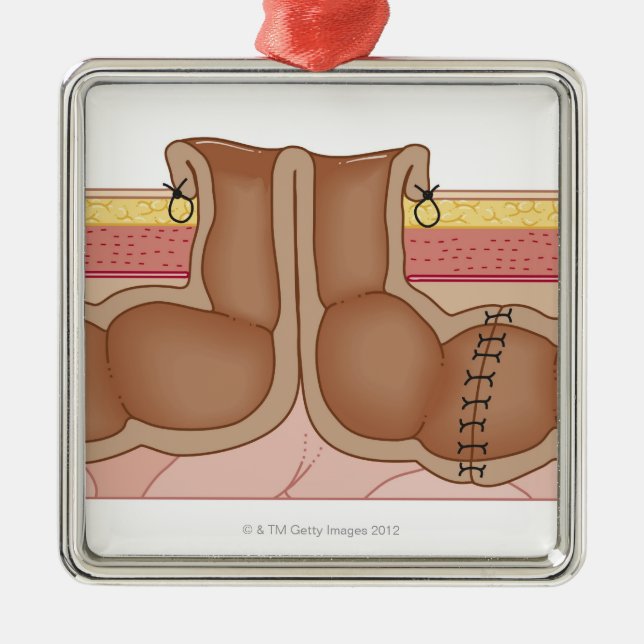 Vorübergehender Colostomy Silbernes Ornament (Vorne)