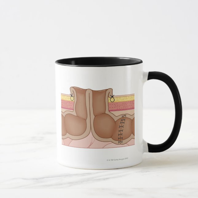 Vorübergehender Colostomy Tasse (Rechts)