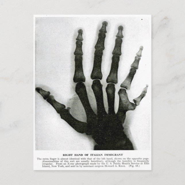 X-Ray Hand mit Extra Finger Postkarte (Vorderseite)