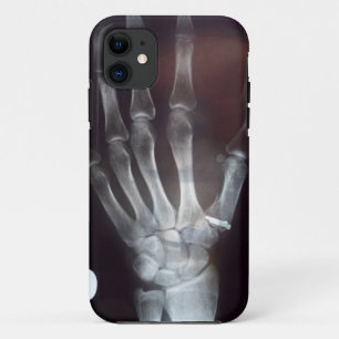 X Strahln-Handtelefon-Kasten Case-Mate iPhone Hülle